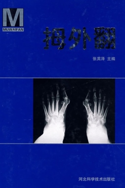 拇外翻封面图